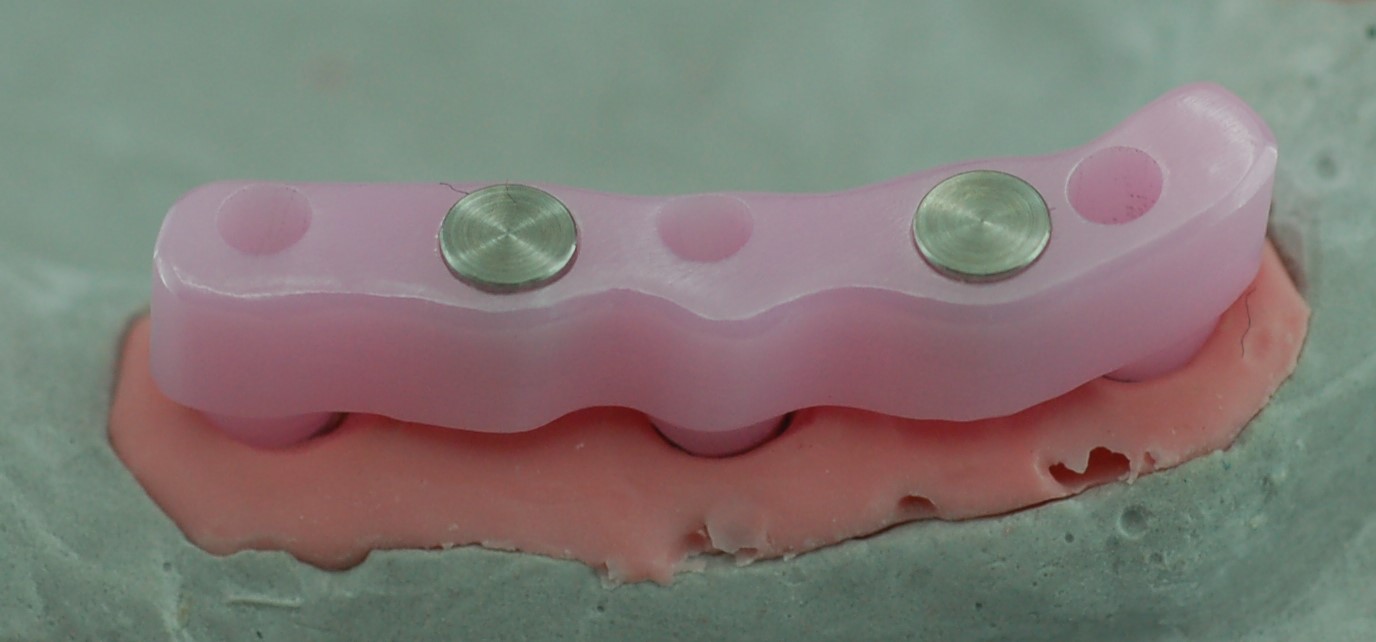Barra implantare in zirconia  IV q°